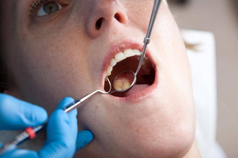 Cavities Treatment