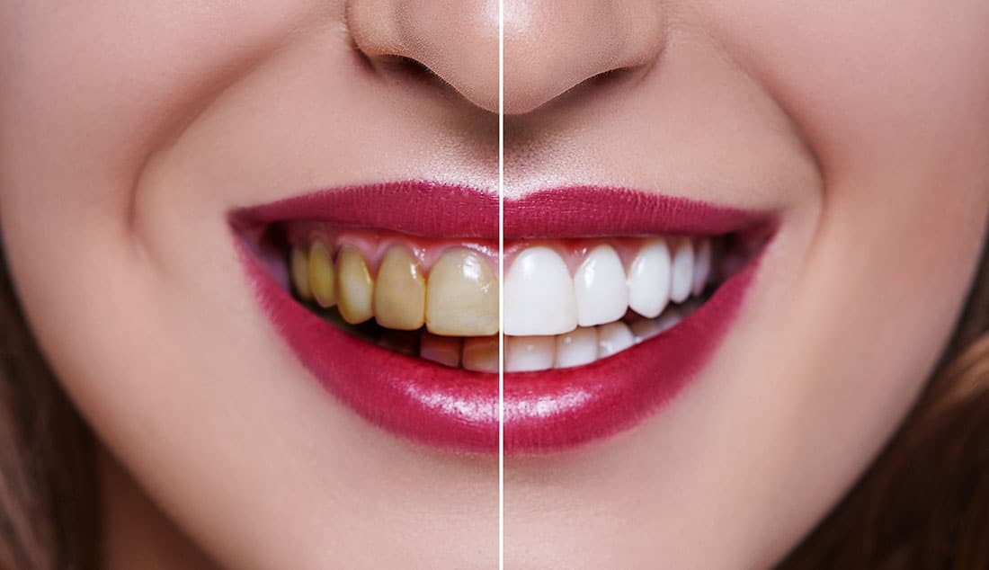 affordable teeth whitening in Melbourne