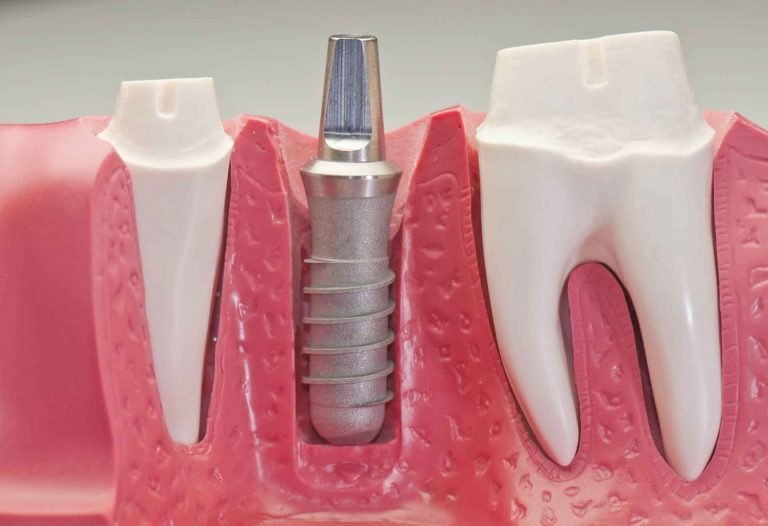 Dental Implants Dentist Anchorage