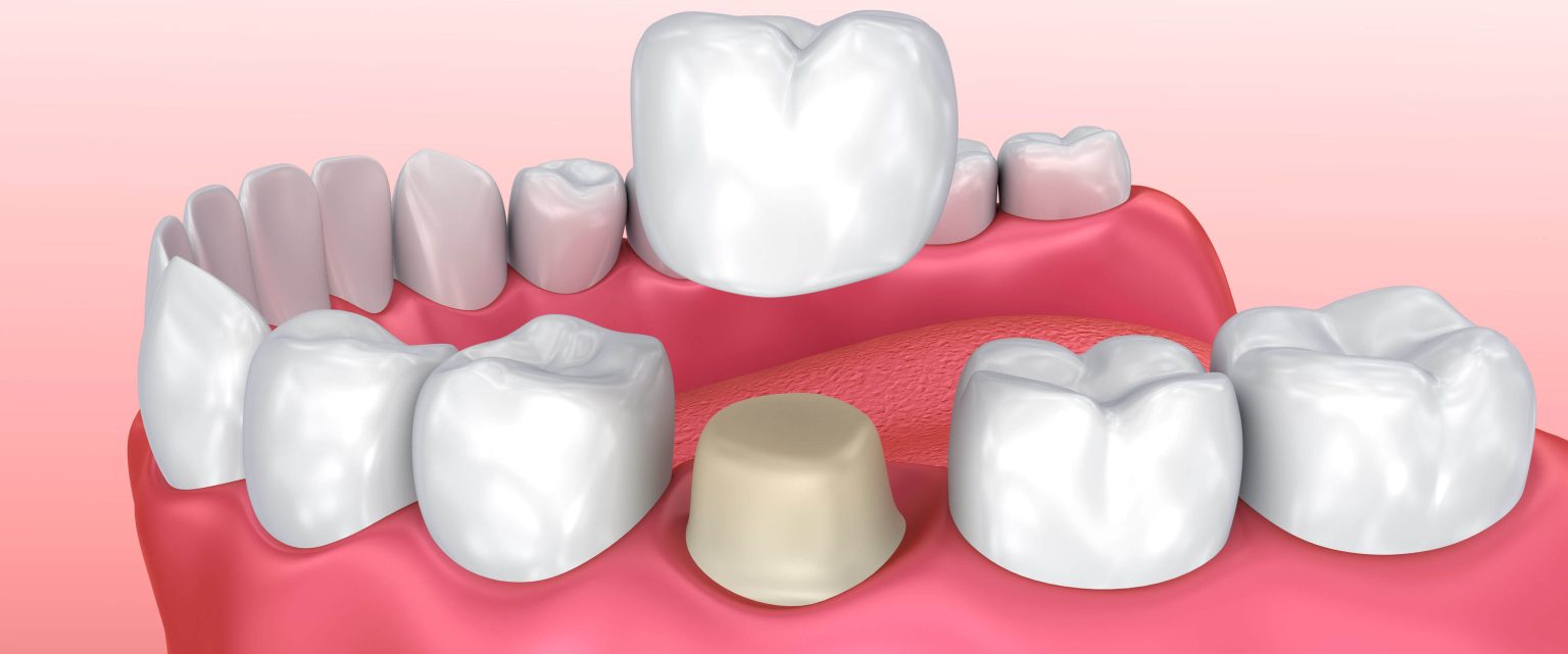 Estimated Dental Crown Costs: Your Guide to Affordable Smile Enhancements